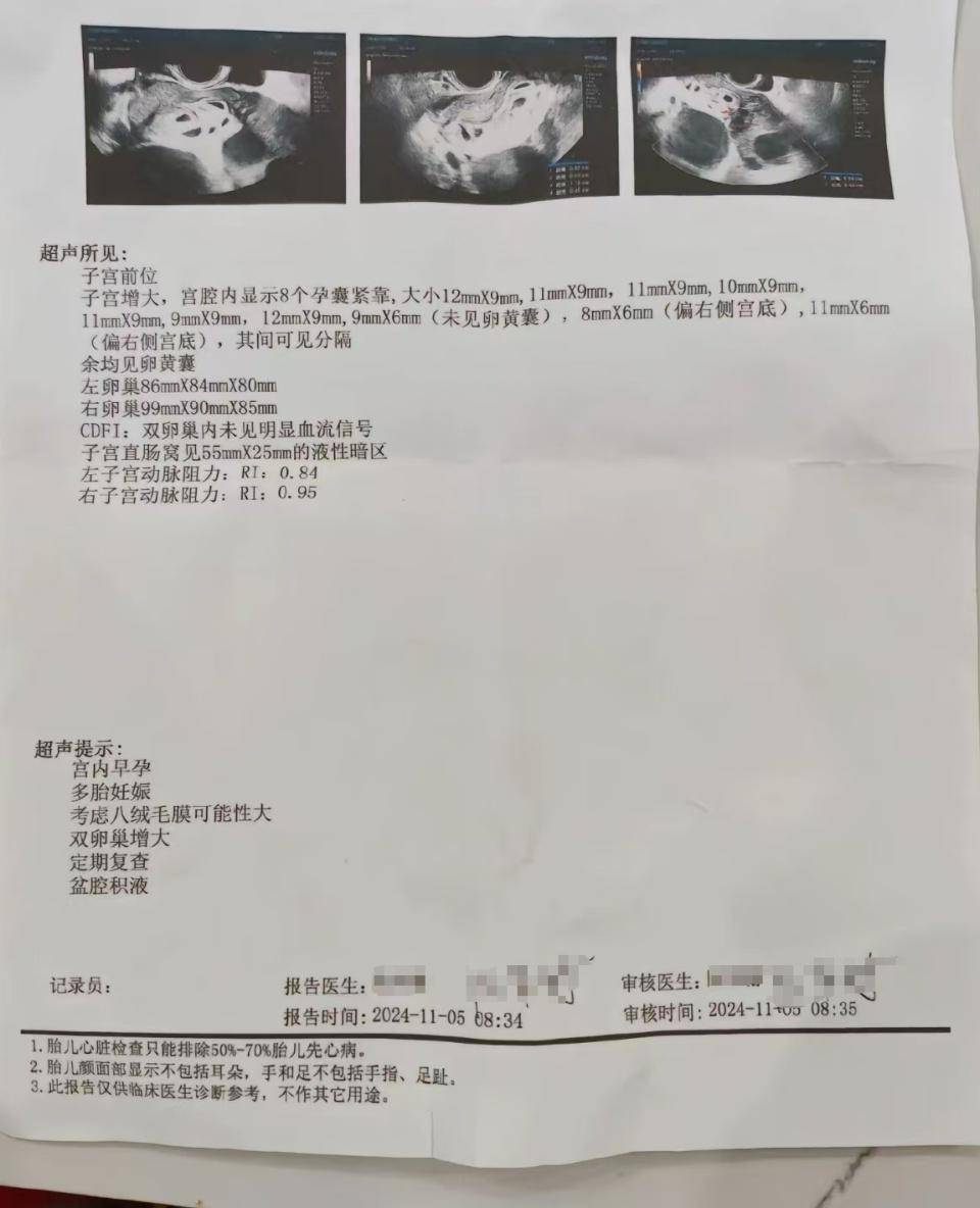 怀上9胞胎女子今日进行减胎手术：分两次进行<strong></p>
<p>非货币交易账务处理</strong>，第一次减去四个胚胎，第二次减去三个