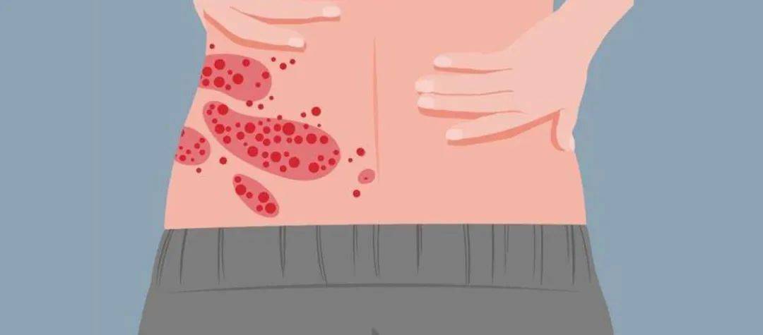 一旦感染终身携带<strong></p>
<p>非货币交易账务处理</strong>！深圳疾控提醒：这4类人要注意