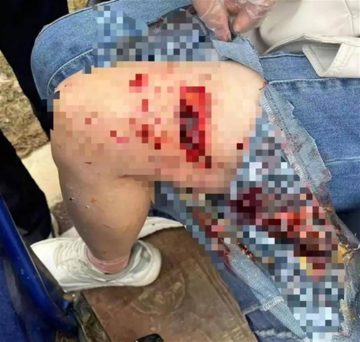 母女散步遭4条大型犬撕咬：狗主人系当地一工程老板 已被采取强制措施