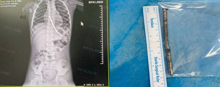 整整40颗<strong></p>
<p>tp钱包下载</strong>！湖南3岁男童身体里取出……医生紧急提醒