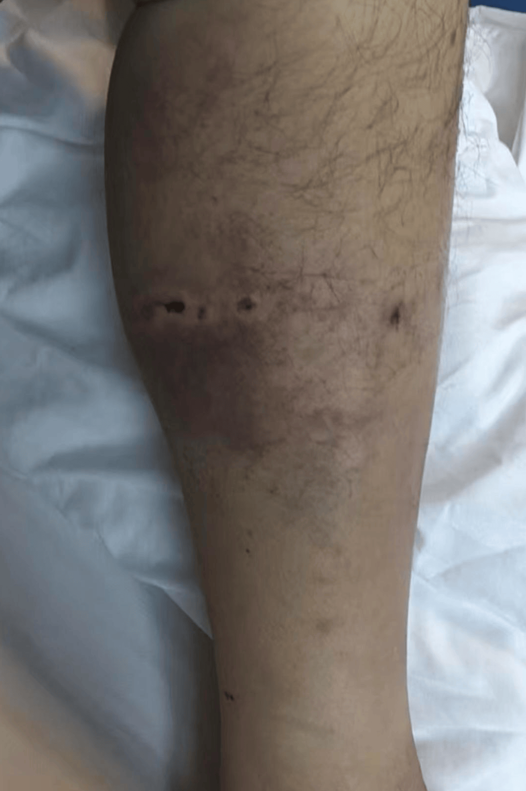 重庆男子上山采菌正面遇黑熊袭击<strong></p>
<p>tp钱包app下载安装</strong>，当事人：小腿被咬，穿的水鞋救了我一命；遭一掌打下山坡后险坠山崖幸被树枝拦住，醒后找到手机求救