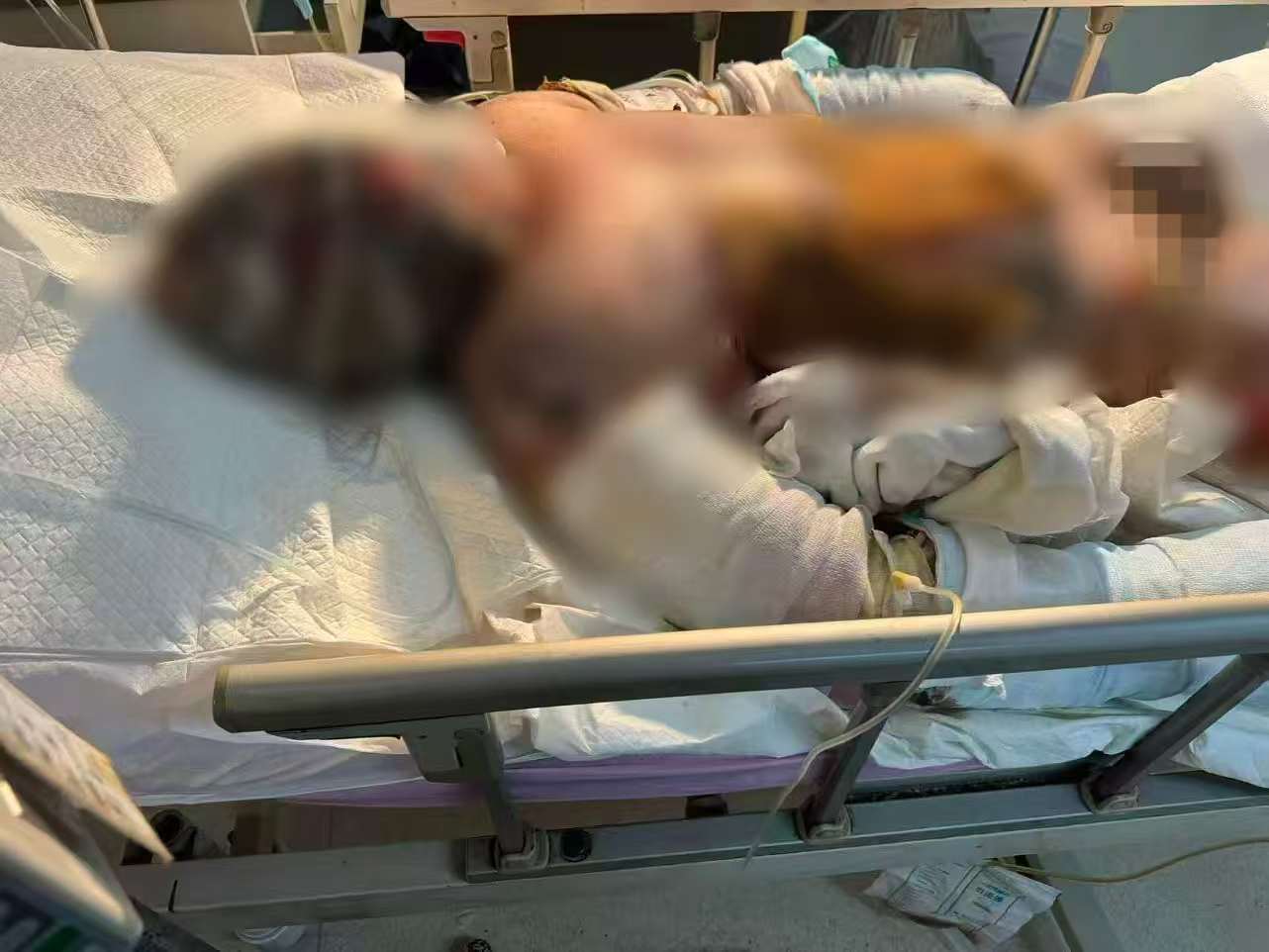 父子在哈尔滨一亲戚公司上班遇爆炸全身烧伤<strong></p>
<p>usdt币</strong>，治疗花费近百万公司拒赔偿？亲戚回应