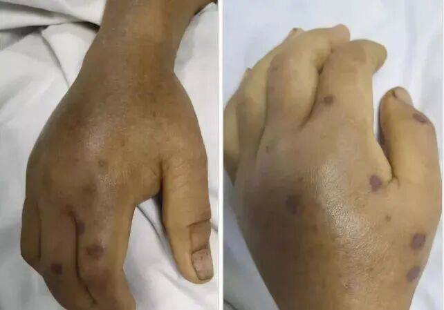 深圳一市民突遭马蜂围袭！已进入高发期<strong></p>
<p>usdt币</strong>，千万别招惹！