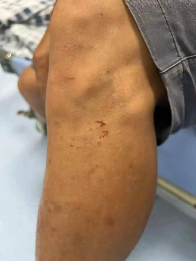 广东62岁阿叔网鱼网到2条眼镜蛇<strong></p>
<p>usdt价格</strong>,被咬伤后当场打死,并打包提进医院