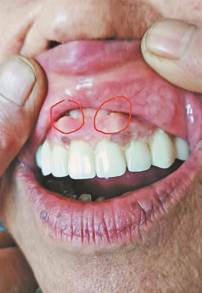 绥化刘先生反映其母亲种牙后，牙龈鼓俩大包，顶嘴唇！哈尔滨市优诺口腔回应