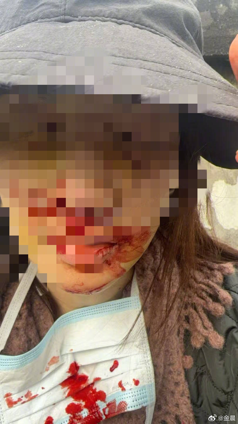 警方发布警情通报后<strong></p>
<p>万泰生物股票</strong>，金晨晒脸部受伤照片并发文道歉