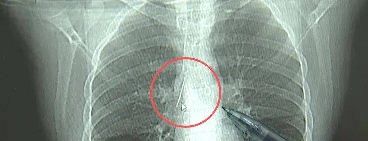 17岁小伙参军体检发现胸腔内有根5cm缝衣针,父母回忆或是1岁时扎入,取出时已锈迹斑斑