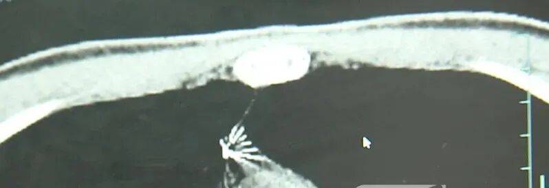 17岁小伙参军体检发现胸腔内有根5cm缝衣针<strong></p>
<p>巨力索具股票</strong>，父母回忆或是1岁时扎入，取出时已锈迹斑斑